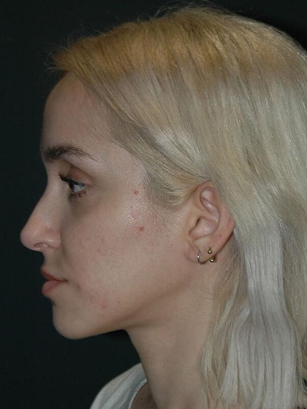 Tear Trough Filler Before & After
