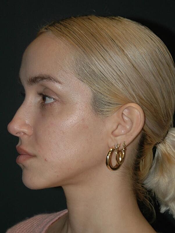 Tear Trough Filler Before & After