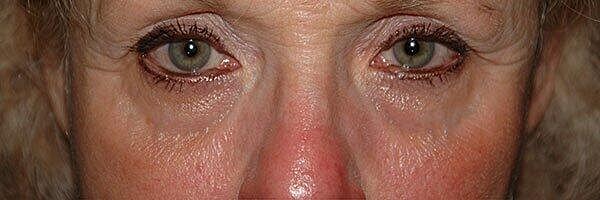Tear Trough Filler Before & After