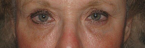 Tear Trough Filler Before & After