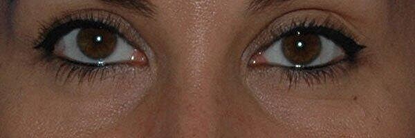 Tear Trough Filler Before & After