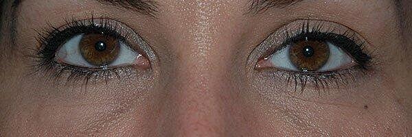 Tear Trough Filler Before & After