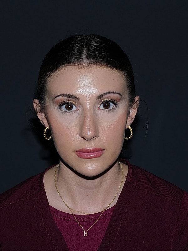 Rhinoplasty Before & After