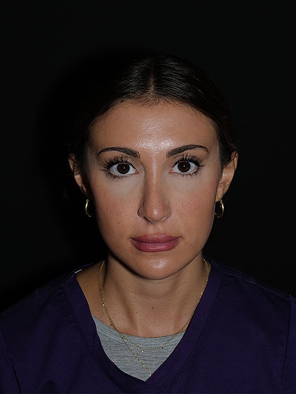 Rhinoplasty Before & After