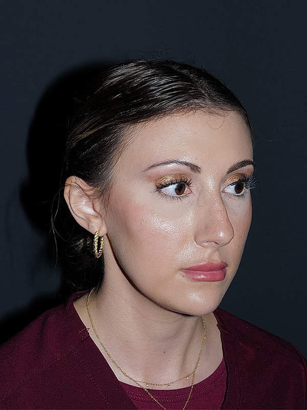 Rhinoplasty Before & After
