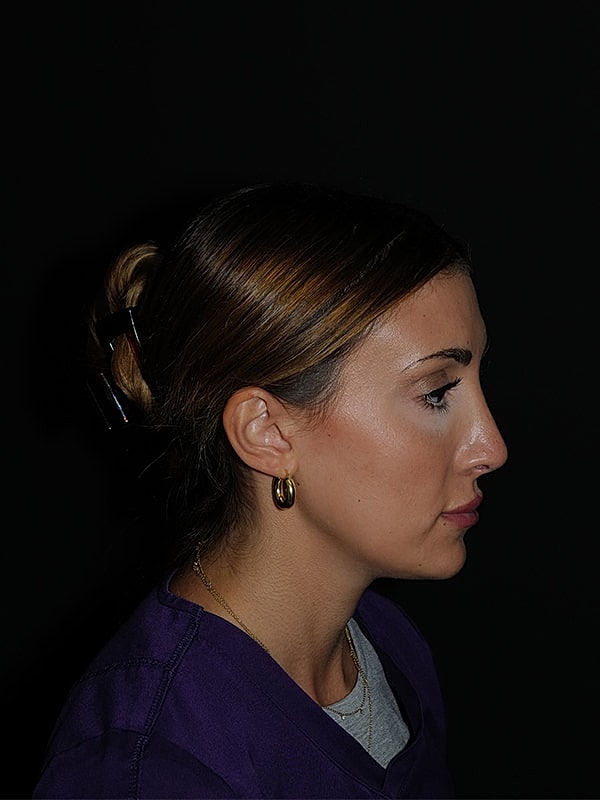 Rhinoplasty Before & After