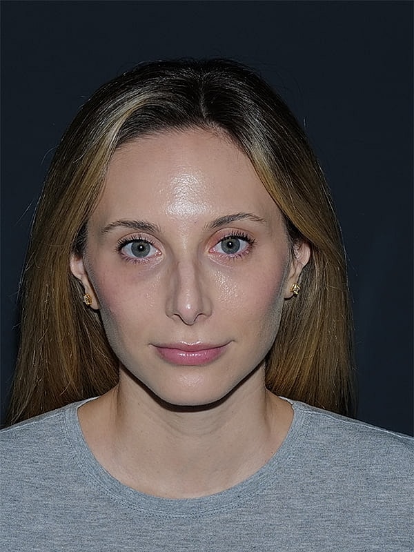 Rhinoplasty Before & After