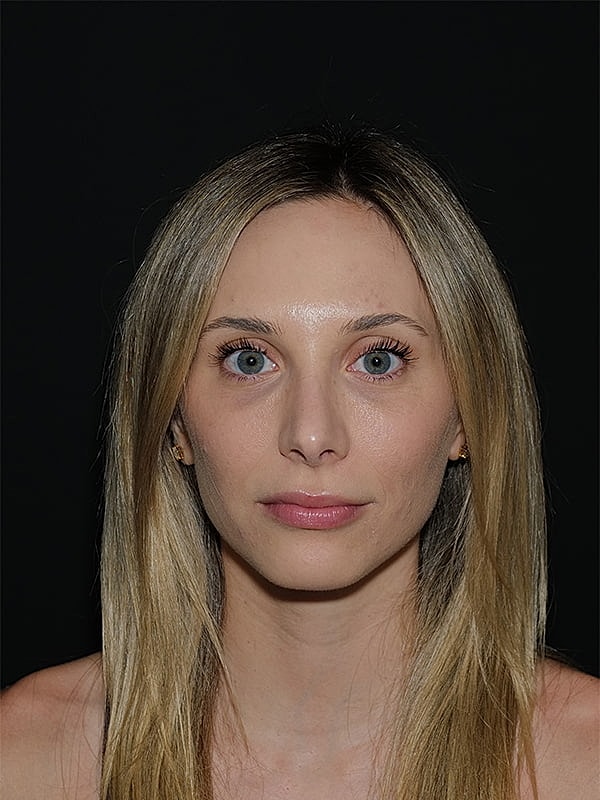 Rhinoplasty Before & After