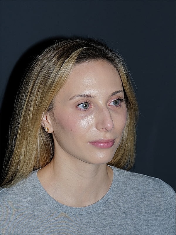 Rhinoplasty Before & After