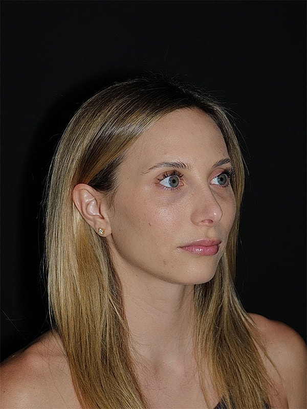 Rhinoplasty Before & After