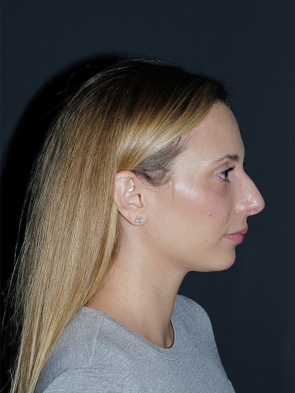 Rhinoplasty Before & After