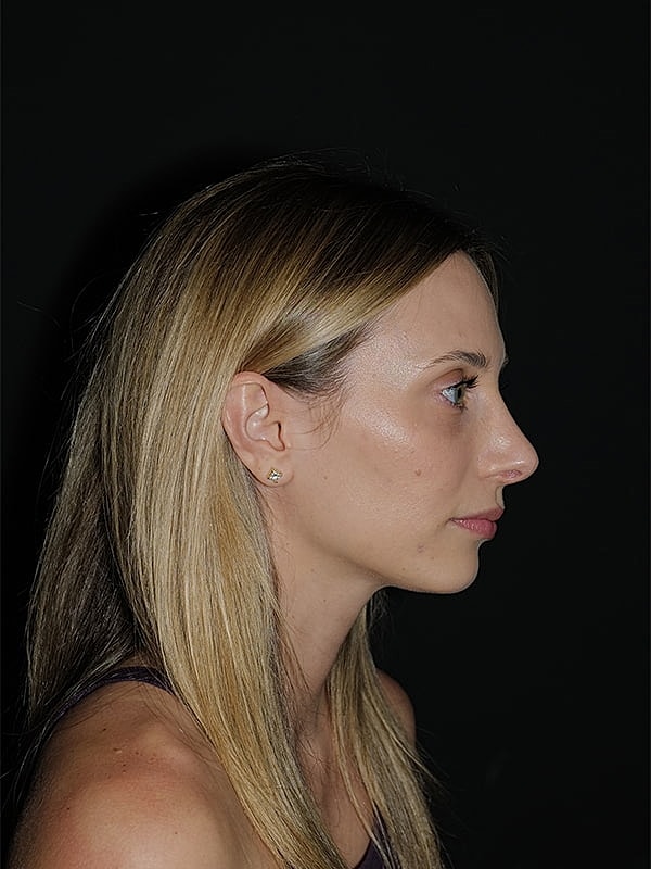 Rhinoplasty Before & After