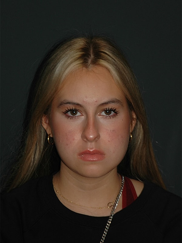 Rhinoplasty Before & After