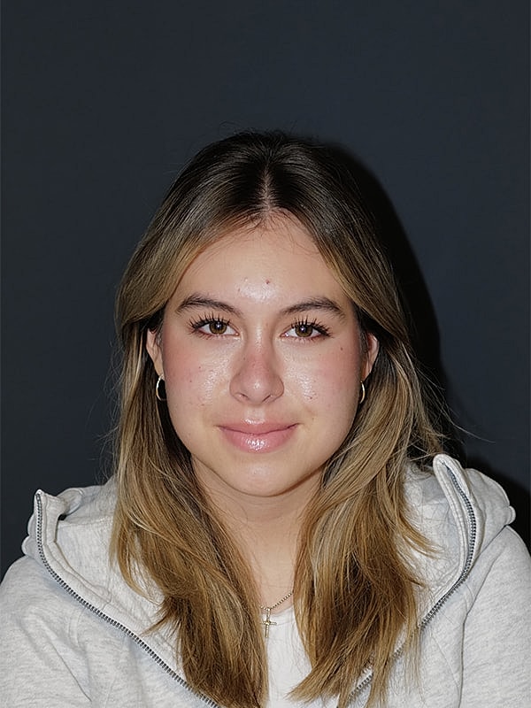 Rhinoplasty Before & After