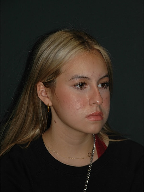 Rhinoplasty Before & After