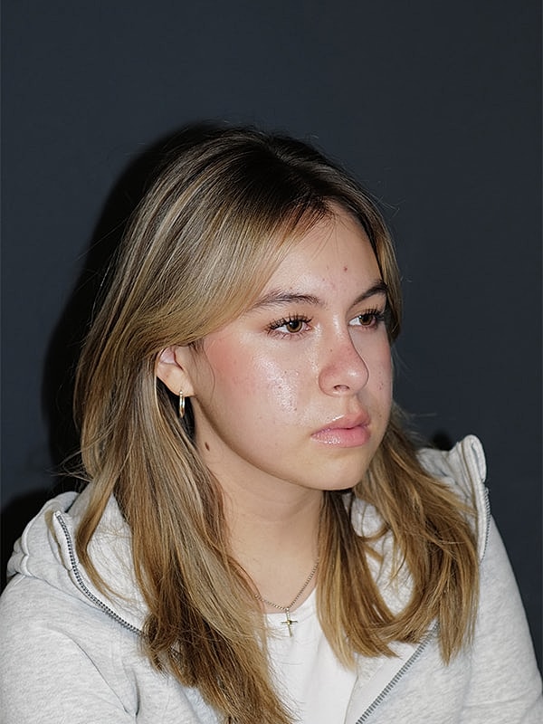Rhinoplasty Before & After