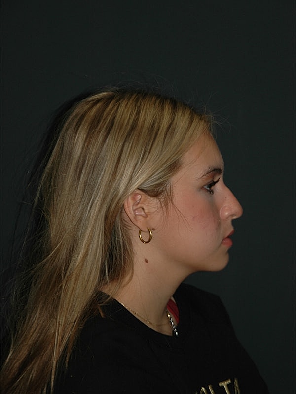 Rhinoplasty Before & After