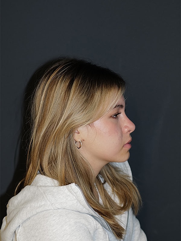 Rhinoplasty Before & After