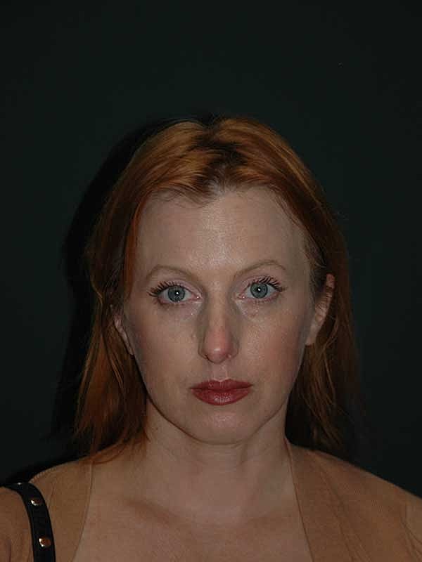 Rhinoplasty Before & After
