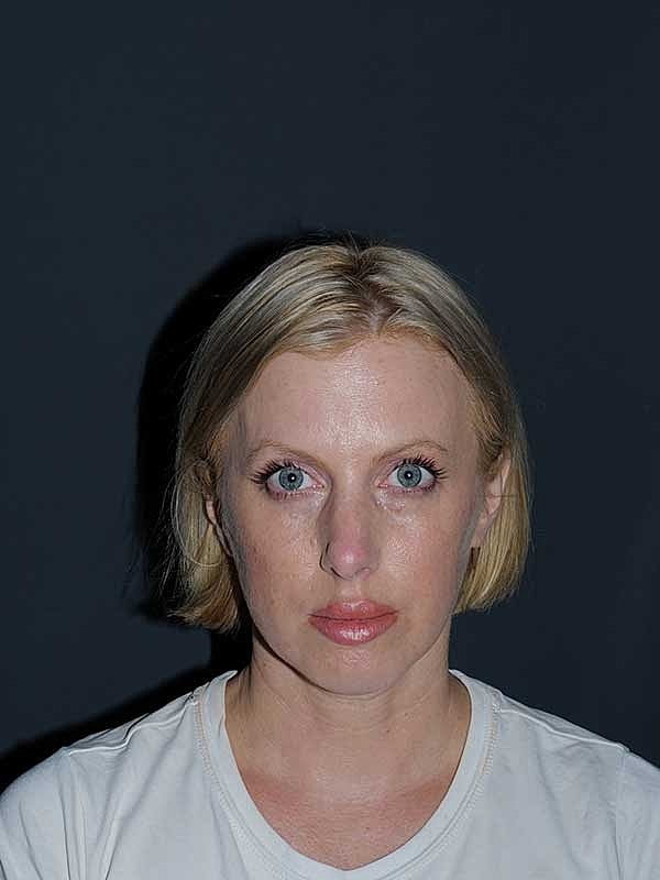 Rhinoplasty Before & After
