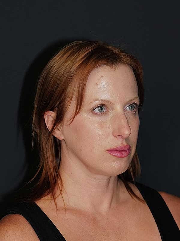 Rhinoplasty Before & After
