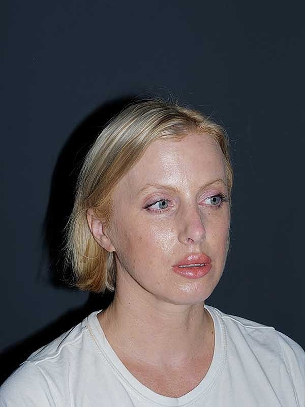 Rhinoplasty Before & After