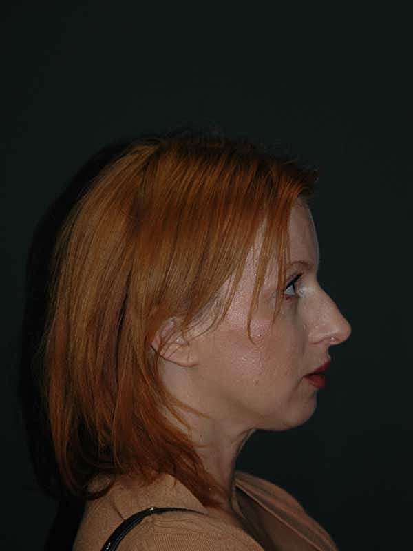 Rhinoplasty Before & After