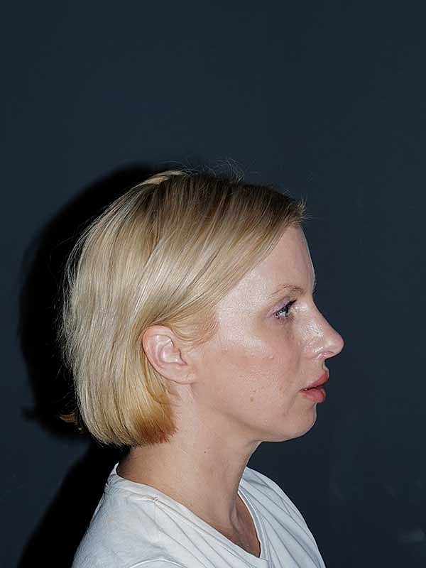Rhinoplasty Before & After
