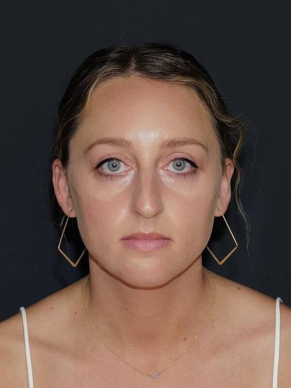 Rhinoplasty Before & After