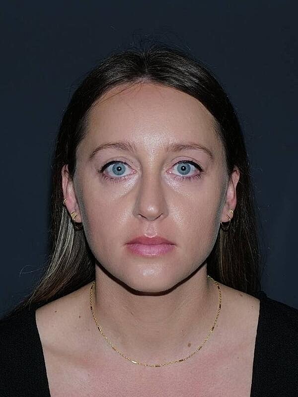 Rhinoplasty Before & After