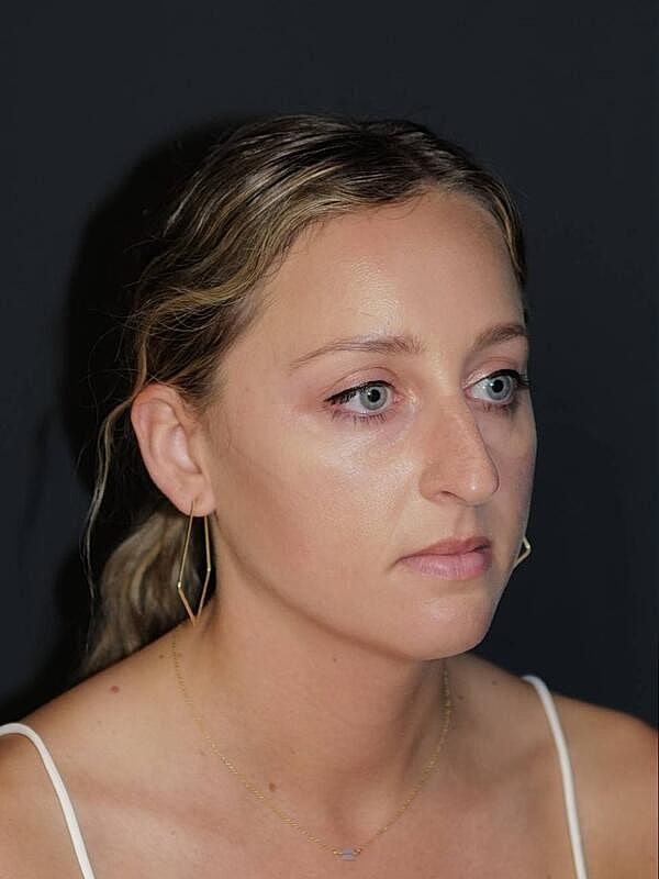 Rhinoplasty Before & After