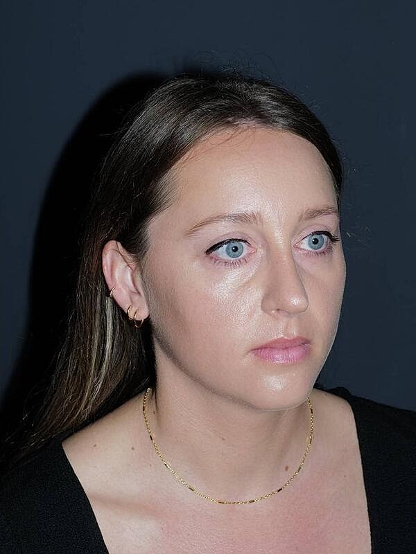 Rhinoplasty Before & After