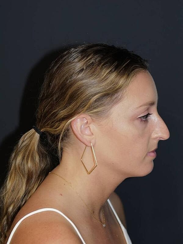 Rhinoplasty Before & After