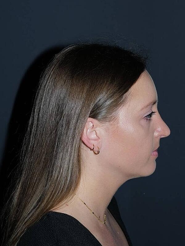 Rhinoplasty Before & After