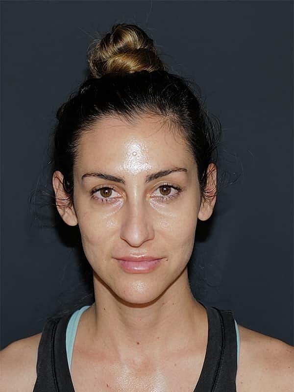Rhinoplasty Before & After