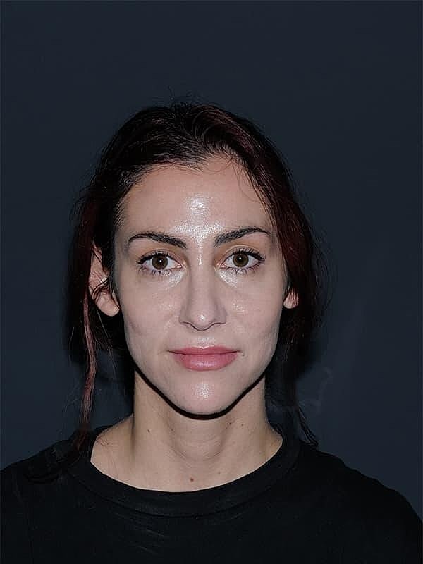 Rhinoplasty Before & After