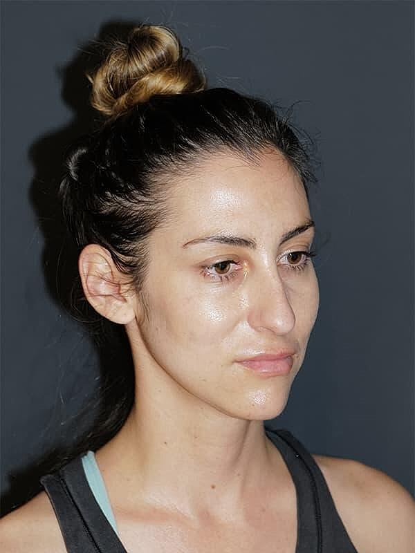 Rhinoplasty Before & After