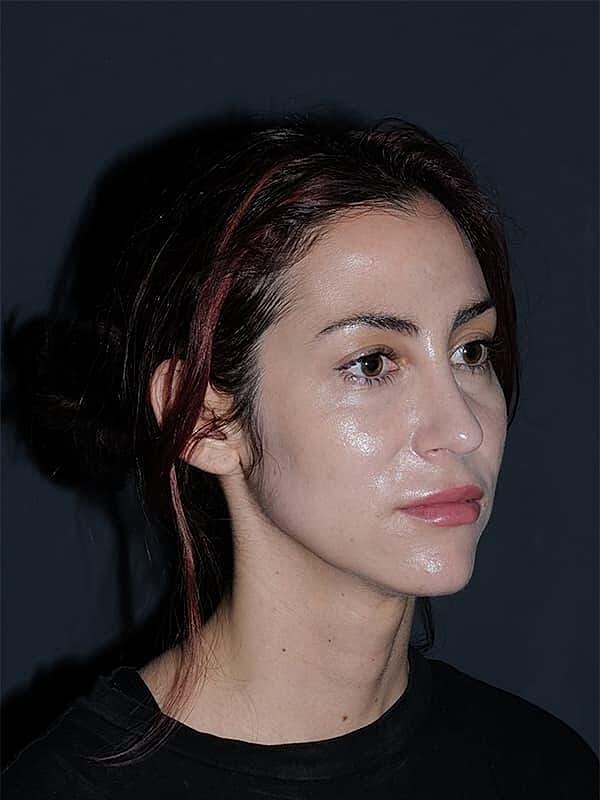 Rhinoplasty Before & After