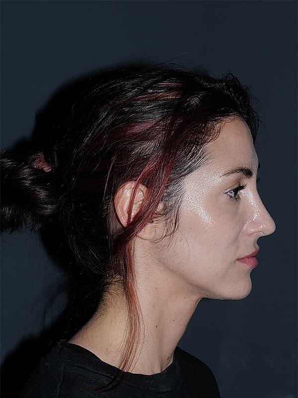 Rhinoplasty Before & After