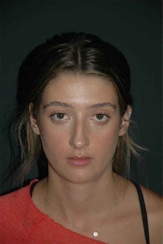 Rhinoplasty Before & After