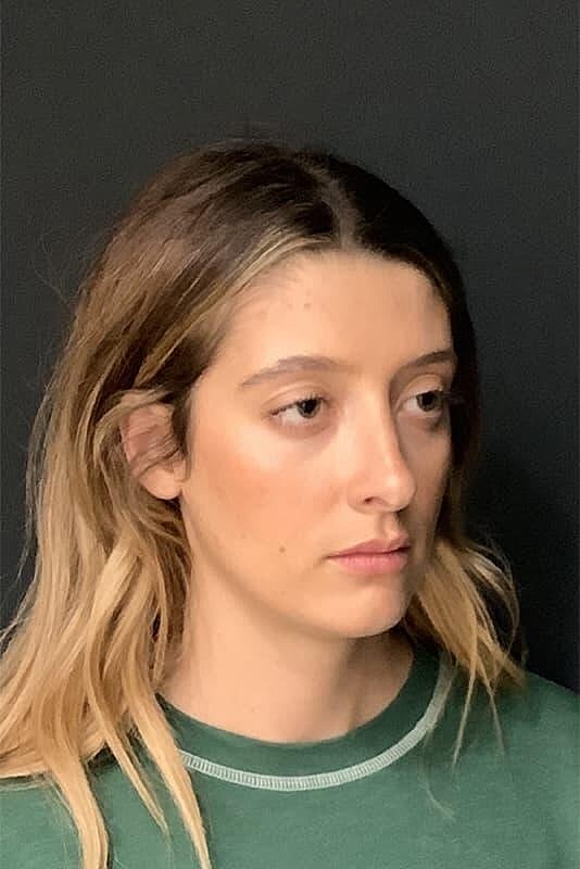 Rhinoplasty Before & After