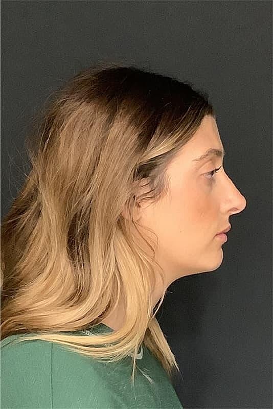 Rhinoplasty Before & After