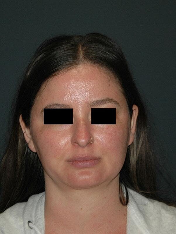 Rhinoplasty Before & After