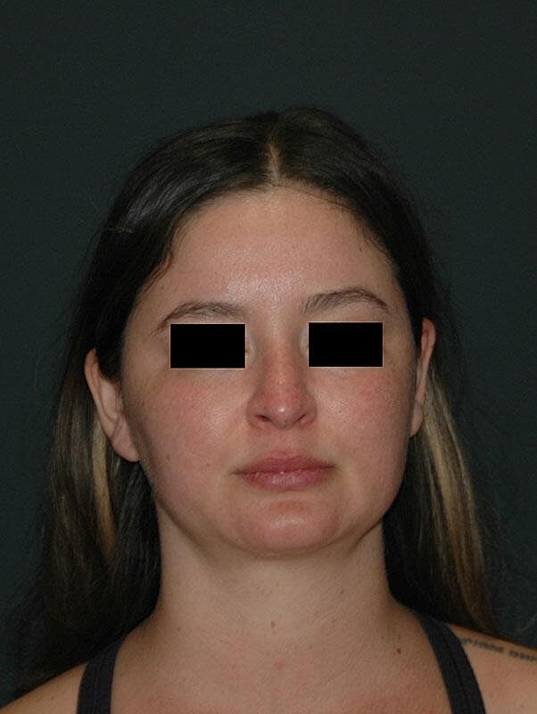 Rhinoplasty Before & After