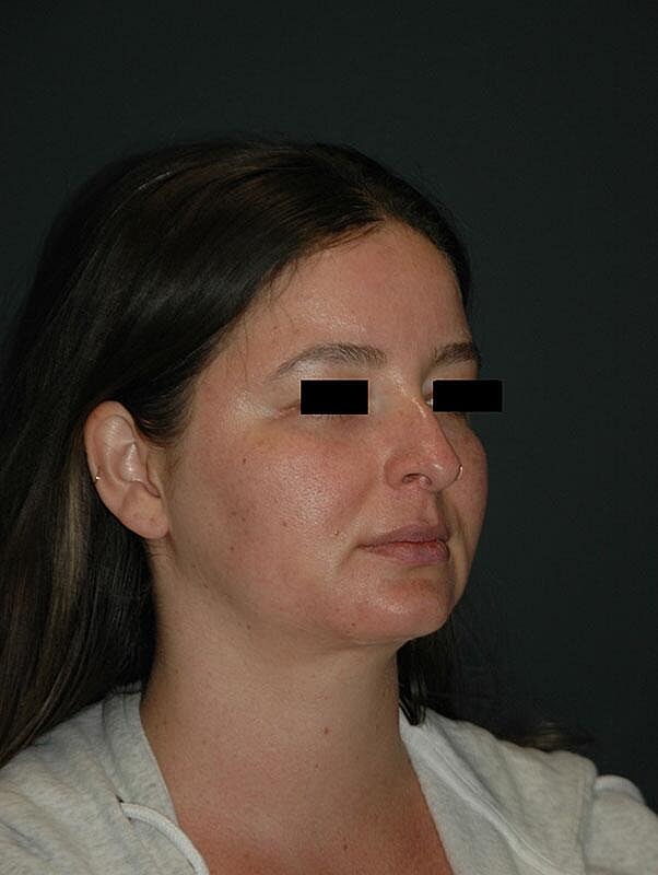 Rhinoplasty Before & After