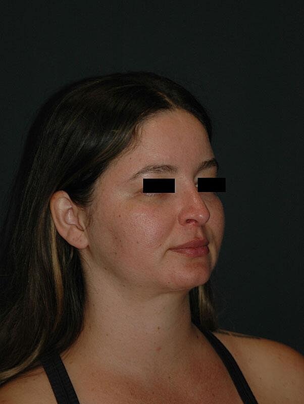 Rhinoplasty Before & After