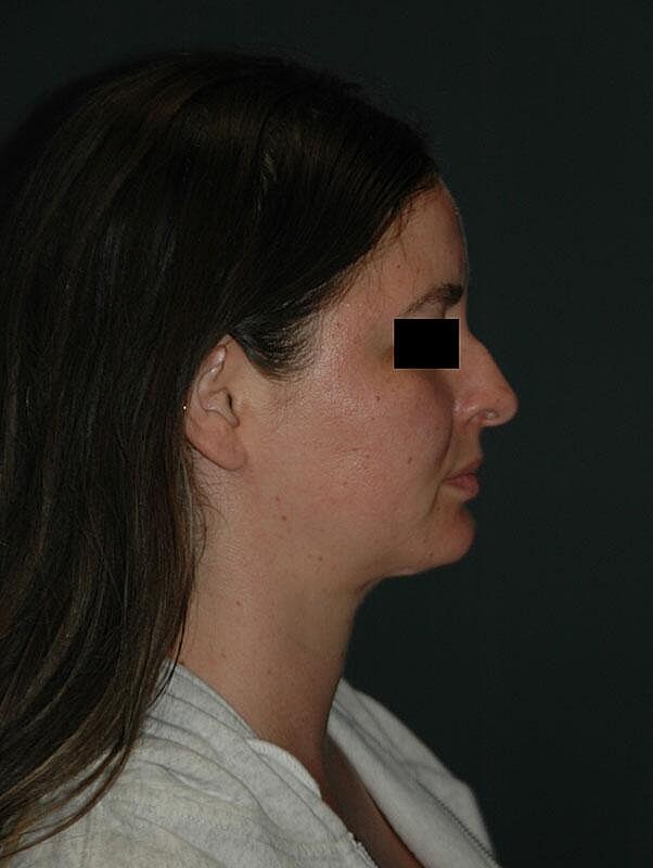 Rhinoplasty Before & After
