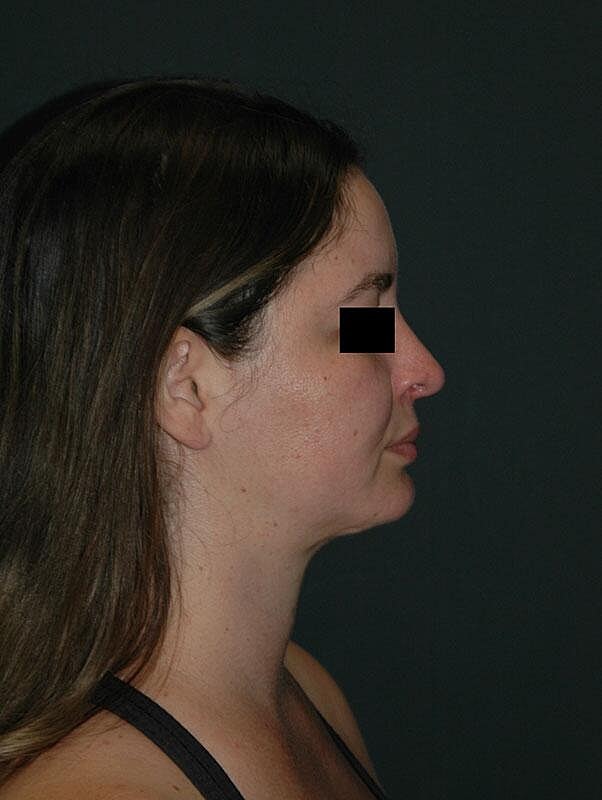 Rhinoplasty Before & After