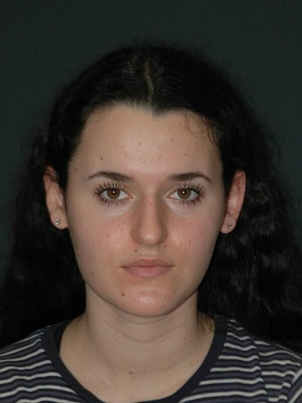 Rhinoplasty Before & After