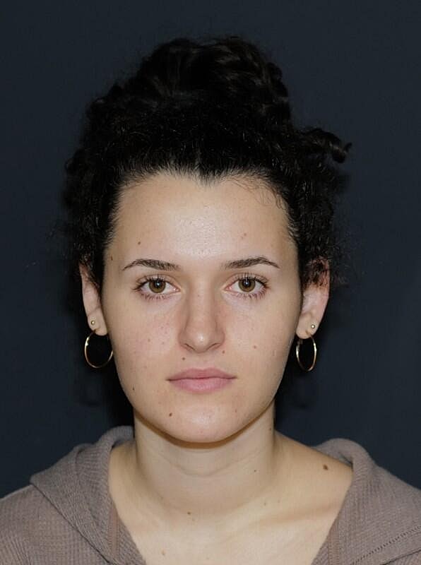 Rhinoplasty Before & After